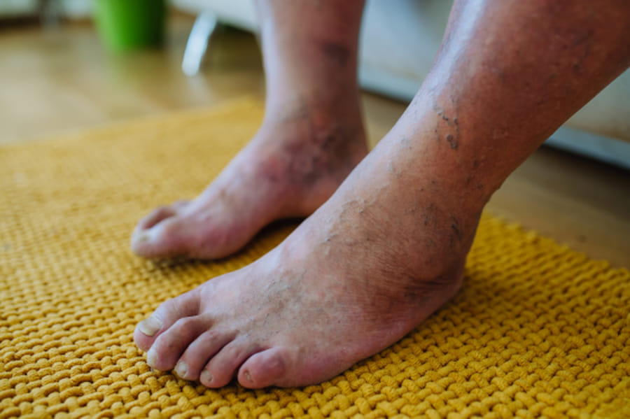 How Neuropathy Can Affect Everyday Life